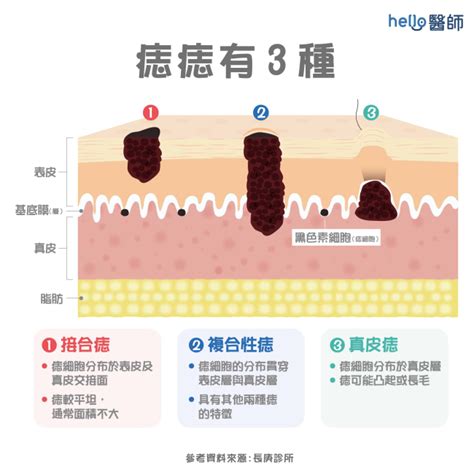 陰莖痣|陰莖陰囊長痣是否為睪丸癌前兆？看醫生是否必要？剃除陰毛與肛。